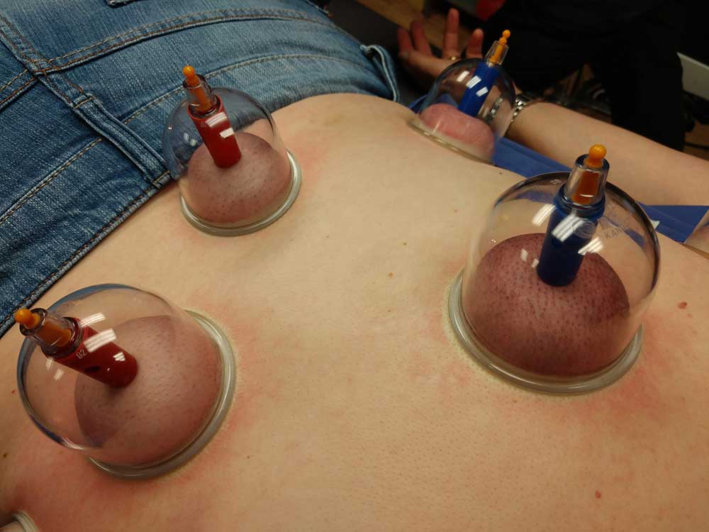 Firsthand Look at Cupping
